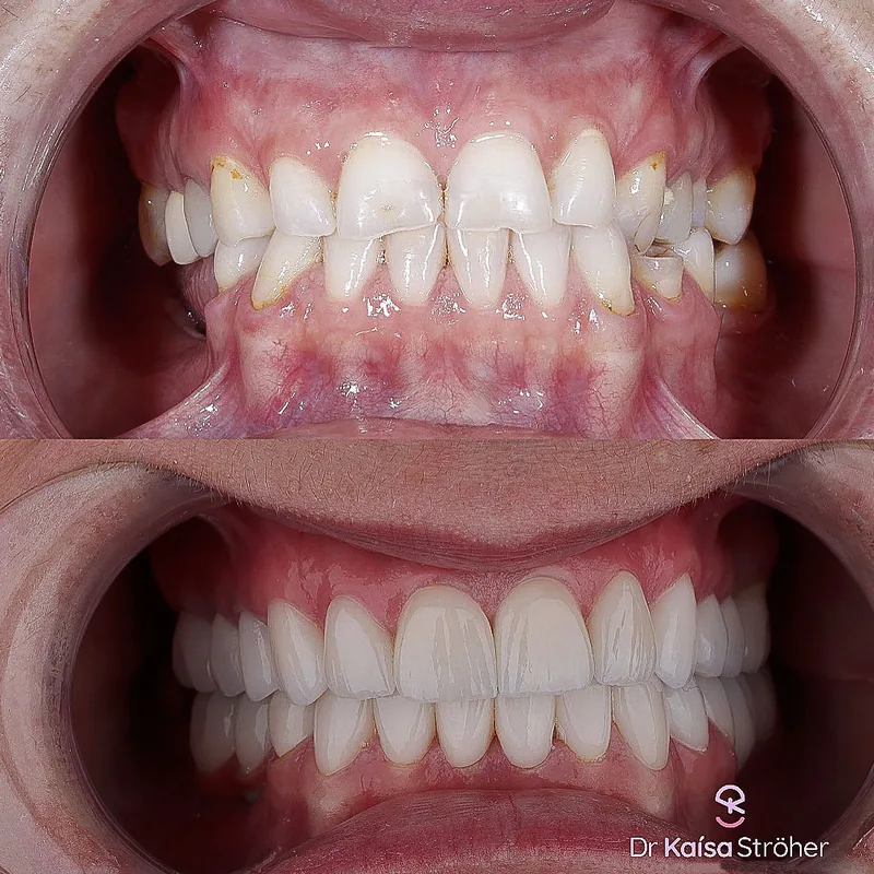 Veneers case by Dr. Kaísa Ströher — before and after 2