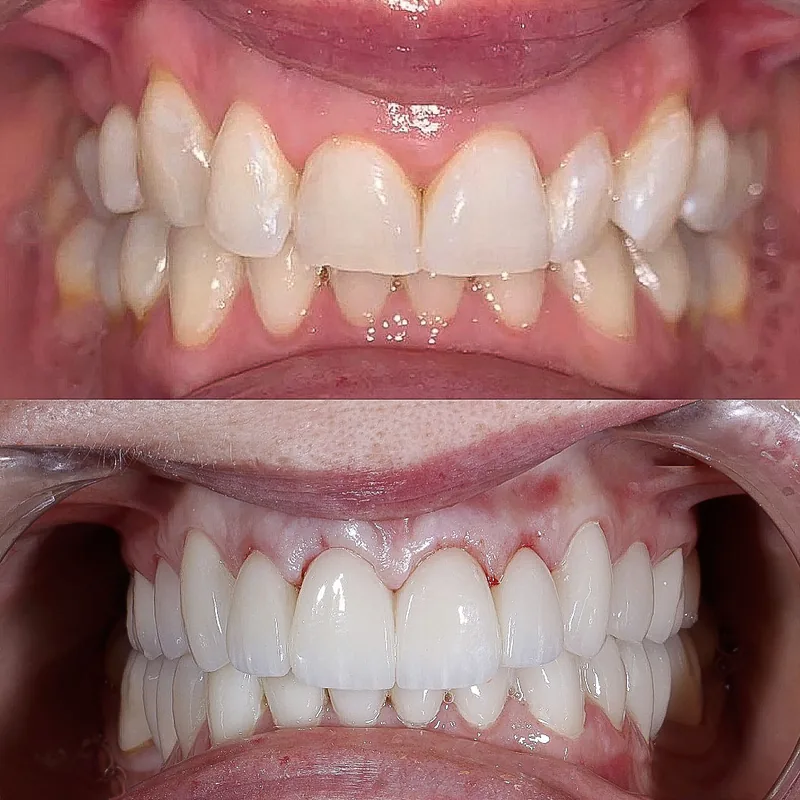 Veneers case by Dr. Kaísa Ströher — before and after 3