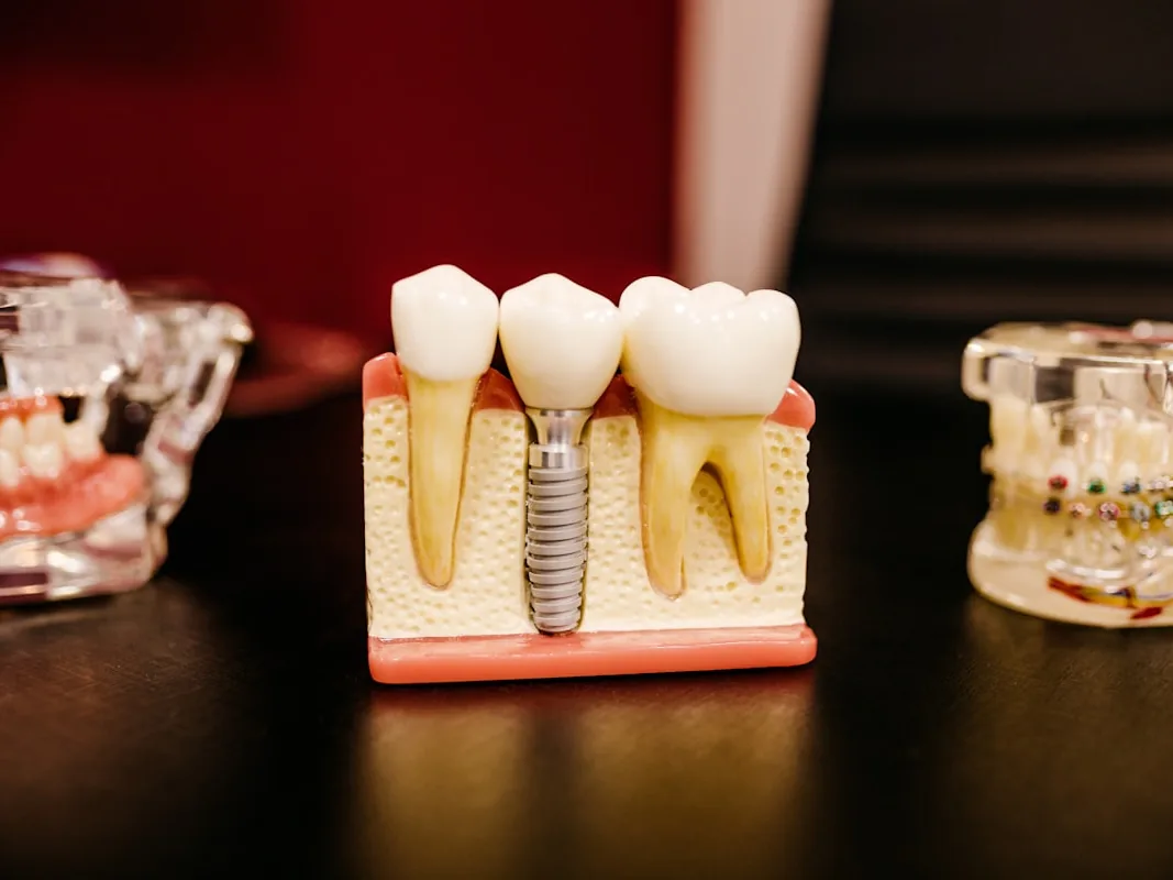 Dental implant model showing tooth replacement