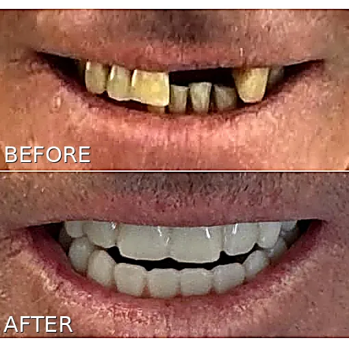 Before and after full-arch dental implant restoration